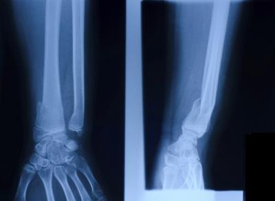 Wrist x-ray. Wrist x-ray.