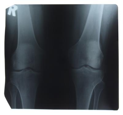 The knee joint is particularly susceptible to injury and arthritis. The knee joint is particularly susceptible to injury and arthritis.