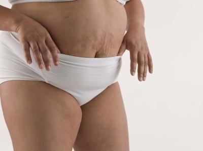 Belly fat can linger even as you shed those other pounds. Belly fat can linger even as you shed those other pounds.