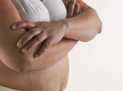 Weight loss or pregnancy can cause sagging skin and cellulite. Weight loss or pregnancy can cause sagging skin and cellulite.