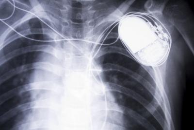 Pacemaker x-ray Pacemaker x-ray