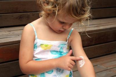 Young girl applying cream to her eczema Young girl applying cream to her eczema