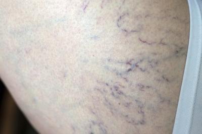 Spider veins. Spider veins.