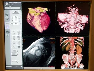 CAT Scan and MRI of human heart and spinal cord CAT Scan and MRI of human heart and spinal cord