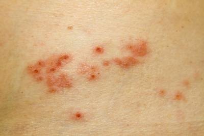Close up of herpes zoster Close up of herpes zoster