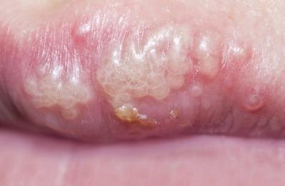 Herpes on the mouth. Herpes on the mouth.
