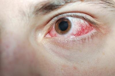 Irritated eye. Irritated eye.