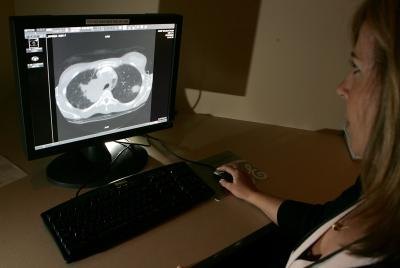 Radiologist viewing CT scan of lungs with thickening. Radiologist viewing CT scan of lungs with thickening.