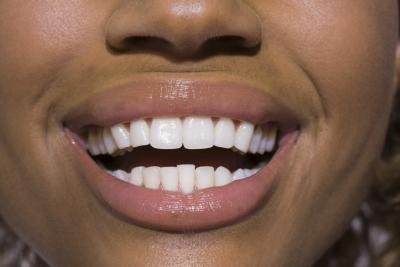 White teeth don't have to come from a strip or a tray. White teeth don't have to come from a strip or a tray.