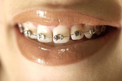 Best Way to Whiten Teeth With Braces Best Way to Whiten Teeth With Braces
