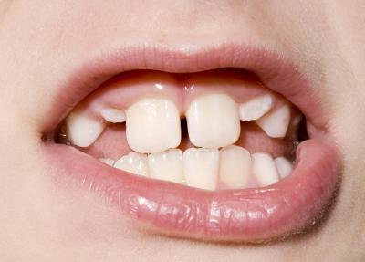 Crowded teeth. Crowded teeth.