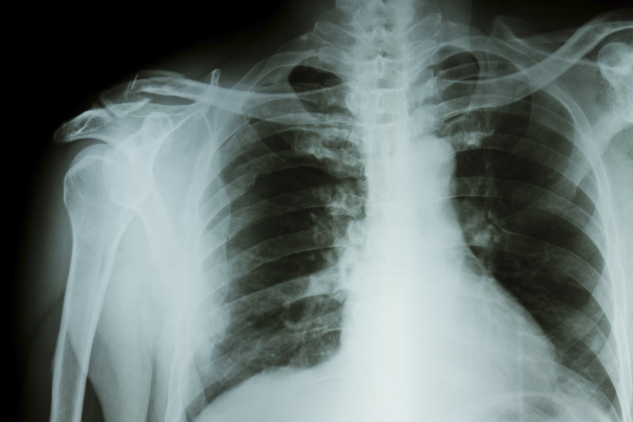 signs-and-symptoms-of-tuberculosis-in-adults-with-pictures-ehow