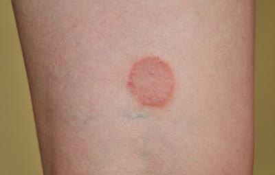 Ringworm of the Skin-Topic Overview - WebMD
