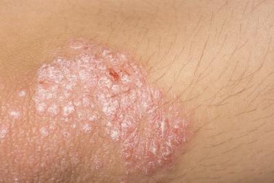 La psoriasi rapidamente per togliere sintomi
