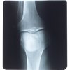 New Treatment to Replace Knee Replacement Surgery | Healthy Living