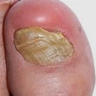 What Are the Causes of Yellow Toenails?