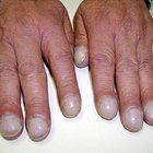 Clubbed Fingers and Heart Disease | eHow UK