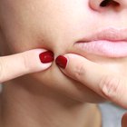 12 Skin Care Tips for Acne-Prone Skin Types