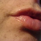Type of Laser for Skin Discoloration