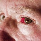 Why Do My Contacts Burn?