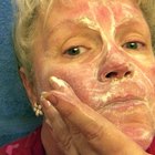 Beauty Tips for Rosacea