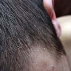 Homemade Solution for Removing Dandruff