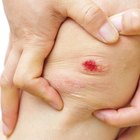Copper Peptides for Wound Healing