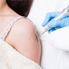 TCA Tattoo Removal Tips