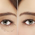 Cosmetic Treatment for Under Eye Bags
