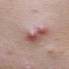 How to Get Rid of Large Pimples