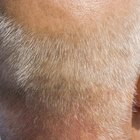 Apple Cider Vinegar & Scalp Psoriasis