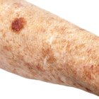 How to Remove Liver Spots Naturally