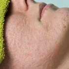Bleach for Acne Scars