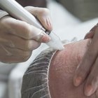 How to Remove Pockmarks From Acne