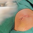 How to Remove Running Sutures