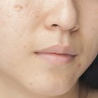 How to Get Rid of Dark Acne Spots