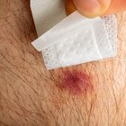 How to Remove Scars Caused by Insect Bites