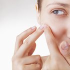 What Causes Whiteheads?