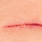 How to Reduce Scars With Supplements