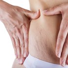 How to Avoid Stretch Marks From Weight Lifting