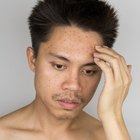 Can You Get Rid of Pimples & Blackheads Quickly, Without Products?