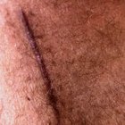 How to Treat Keloids With Aldara Cream