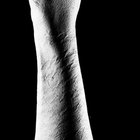 Can You Reduce Collagen Production?