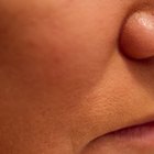 How to Clean Pimples on Your Face