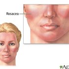 How to Treat Rosacea With Green Tea
