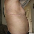 How to Get Rid of Surgical Scars