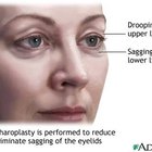 Does Lack of Sleep Lead to Baggy Eyes?