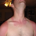 Why Do We Need Sunscreen?