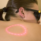 Can You Get Rid of Acne Scars in Two Weeks?