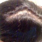 Como tomar o beta-sitosterol para combater a perda de cabelo
